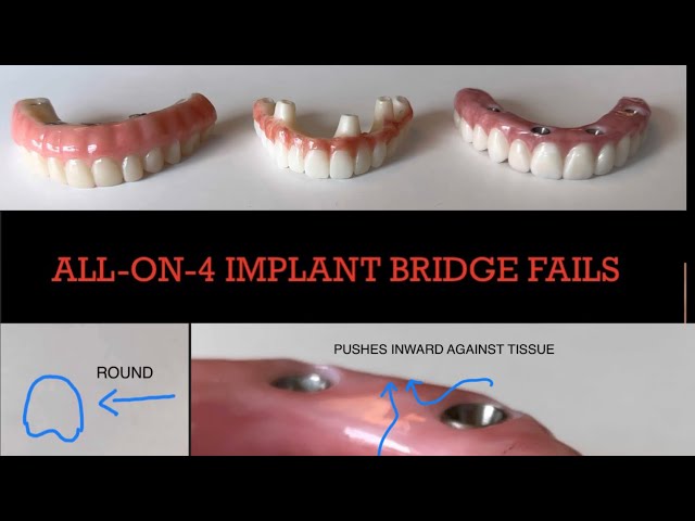 HUGE Failures with All on 4 Dental Implant Bridges