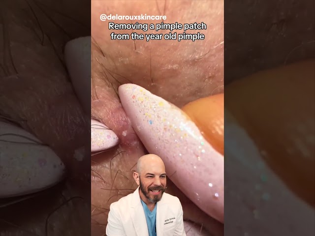 Removing a year old pimple patch👀? (credit:delarouxskincare on TT) #pimple #satisfying #dermatology
