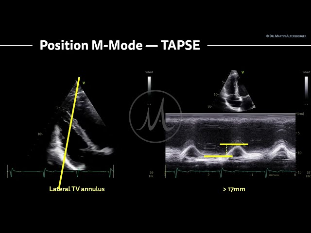 〖Echocardiography〗 TAPSE - right ventricular function with M-Mode