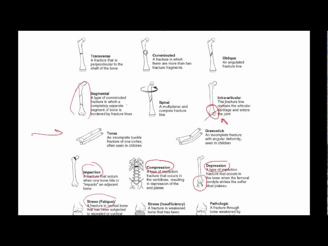 General principles of ortho trauma for PA students 1 - basics
