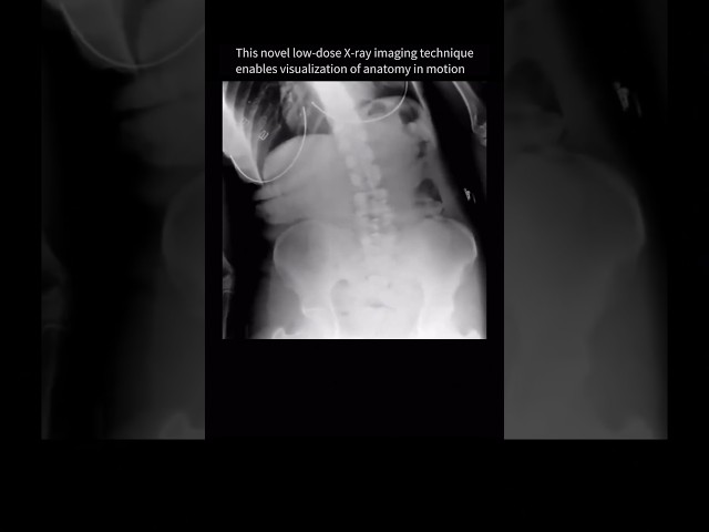 Spine movement seen for the FIRST-TIME with dynamic X-Ray #backpain #anatomy