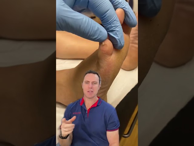 / docpods #callus little toe corn and callus removal by podiatrist corns and callus in this location