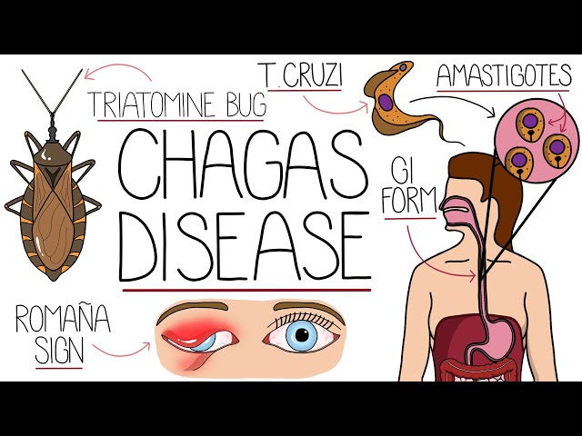 Chagas Disease Explained Clearly (American Trypanosomiasis)