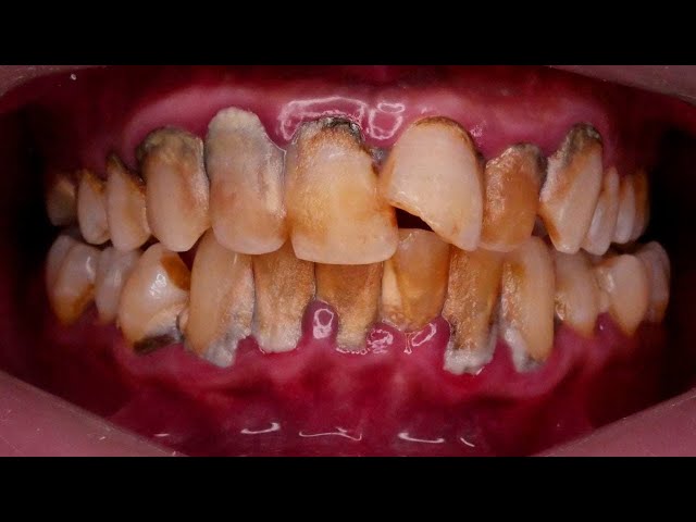 DON'T LET TARTAR COVER YOUR TEETH | Dentist | Dokter Gigi Tri Putra