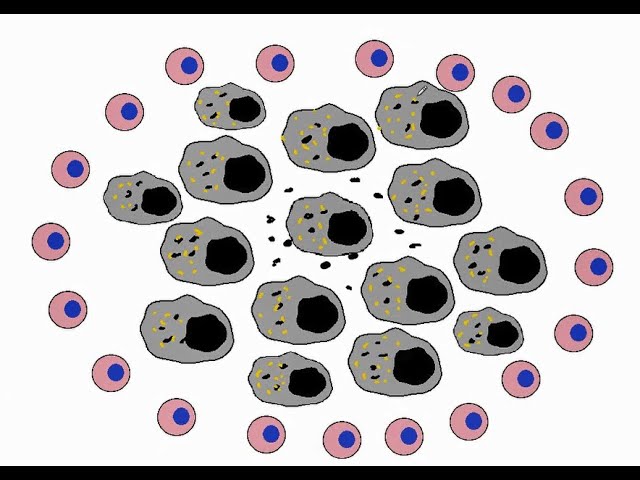 GENERAL PATHOLOGY 23 : tuberculosis types of infection and reaction DR SAMEH GHAZY