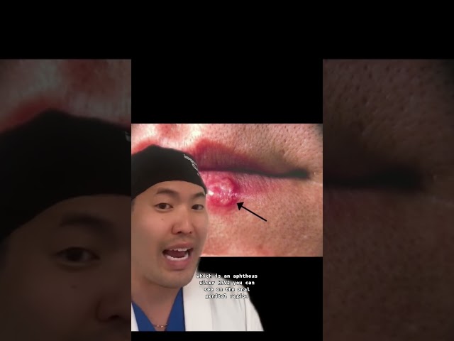 Cold Sores/Herpes Simplex Explained by a Dermatologist