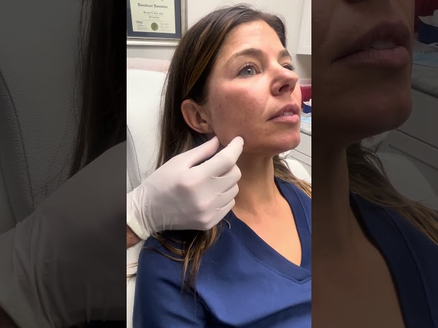 Masseter Muscle Hypertrophy / Jaw Pain Treated with Xeomin (Botox) #cosmeticdermatology