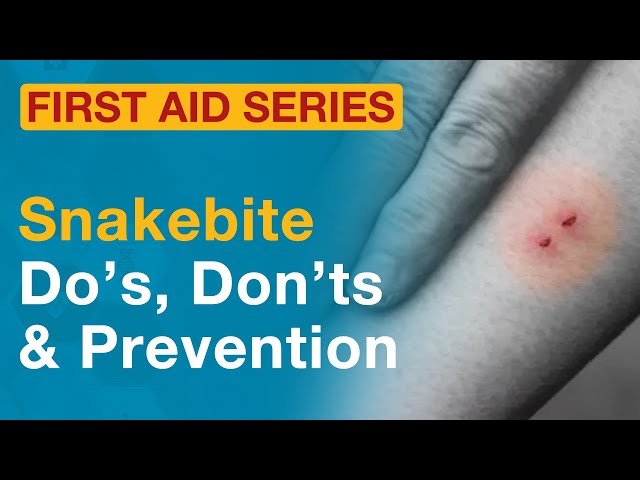 Understand snakebite, recognize the signs, learn how to provide first aid. Dr. Praveen Sodhi