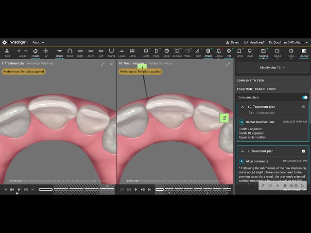 Make Your Simple Aligner Movements "Actually" Simple