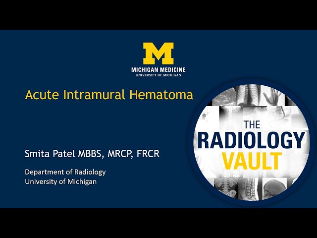 CT of Acute Intramural Hematoma