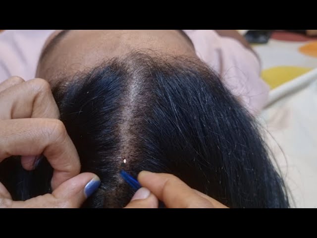 💤 You’ll Be Asleep Before This Ends | Relaxing Scalp Therapy Session 😴✨