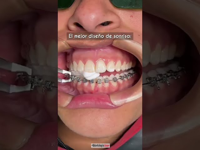 El mejor diseño de sonrisa / Adiós Brackets - Odontología Láser #Shorts
