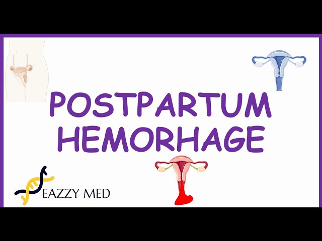 Postpartum Hemorrhage (PPH) causes,risk factors,prevention and treatment