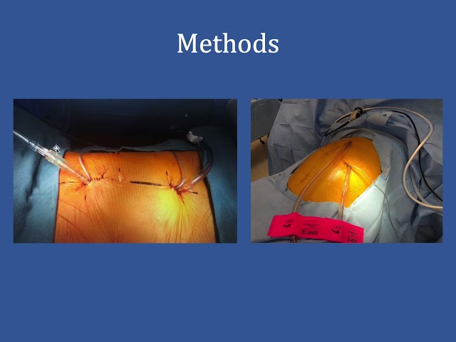 Laparoscopic HIPEC: Effectiveness Study