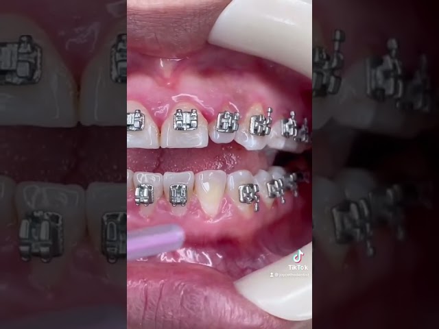 How Braces Brackets are Glued on - A dentist explains the steps #shorts #braces