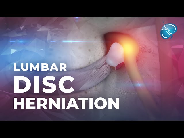 What is Lumbar Disc Herniation? | Herniated Disc