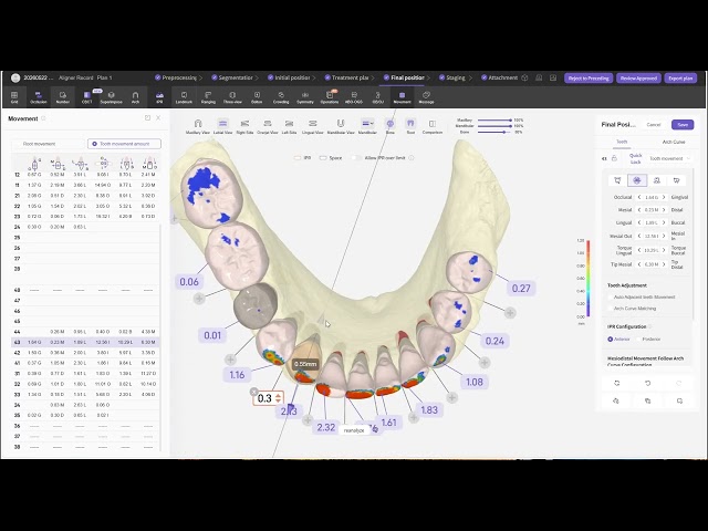 Treatment plan closes gaps, paving the way for mandibular posterior implants and  anterior veneers.