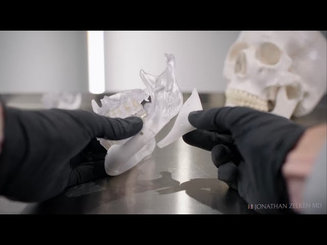 Jawline Implants | Orange County Plastic Surgeon Explains #FacialImplants #jawlinegoals