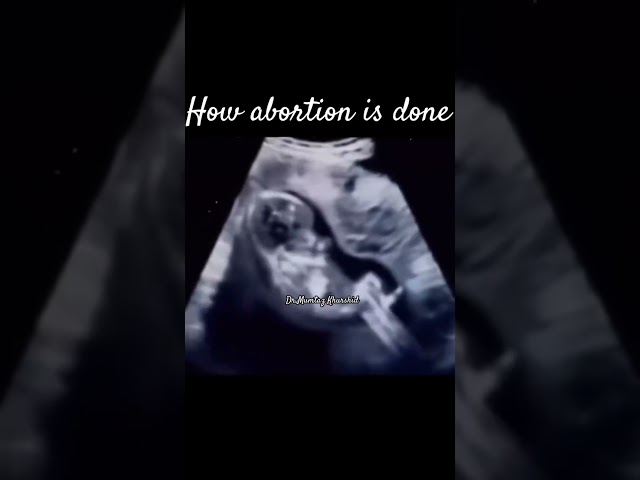 How Abortion Is Done? Abortion on Realtime Ultrasound