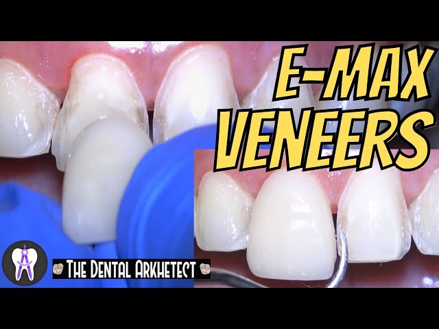 EMAX Porcelain Veneer! HOW Do they DO it? #C41 #4k