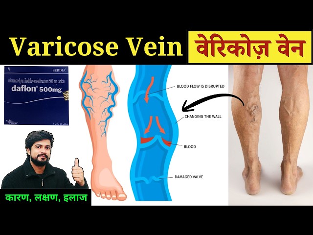 Varicose Vein - Cause, Symptoms Treatment | वेरिकोज़ वेन क्या होती है?  Nursing | Pharmacy | Daflon