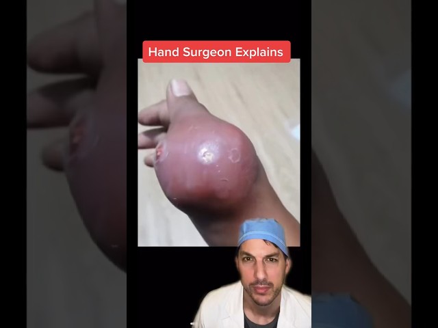 Gout hurts! #gout #Thumb #Pain #UricAcid #Toe #Surgeon #Dr #Medical #Educational #Nurse #Hand