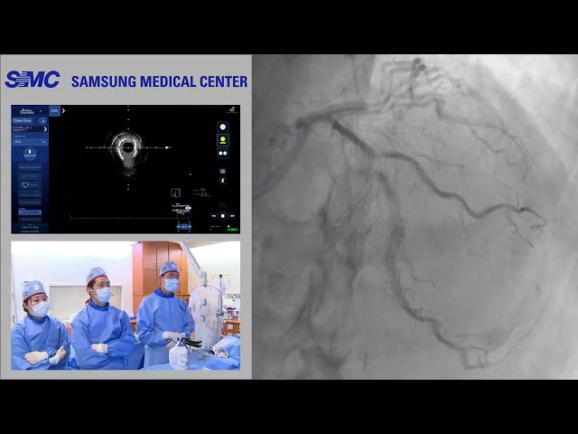 ENCORE SEOUL 2025 Live Demonstration (Complex PCI)_Hyeon-Cheol Gwon, MD/PhD (Samsung Medical Center)