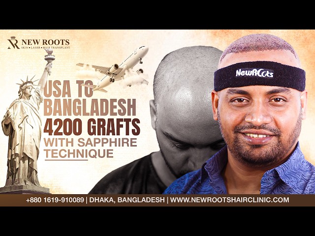 He Flew From the USA for THIS Hair Transplant! 😲 | Grade 5 Baldness | Hair Transplant in Bangladesh