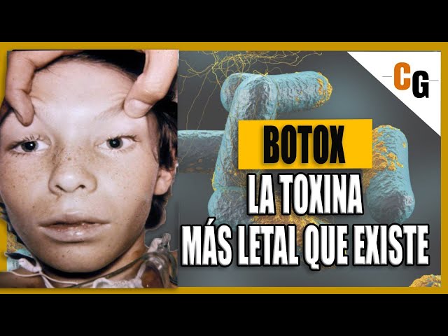 Toxina Botulínica - Botox LA TOXINA mas PODEROSA del Mundo - Fisiopatología y Síntomas del Botulismo