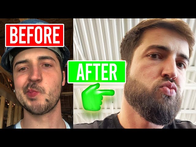 Ultimate Beard Growth Guide: Minoxidil & Micro-Needling