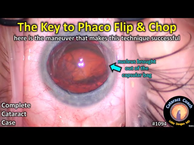 CataractCoach 1094: the key to success with phaco flip and chop