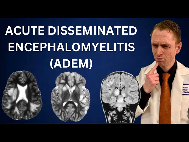 Acute Disseminated Encephalomyelitis (ADEM) Explained by Neurologist