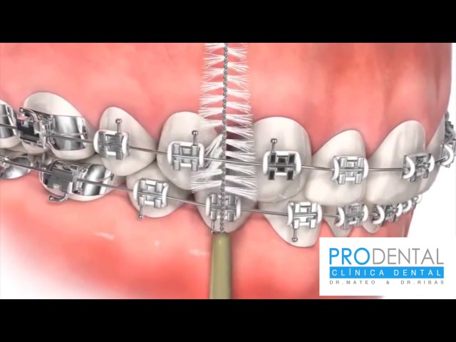 ¿Cómo lavarse correctamente los dientes con brackets?