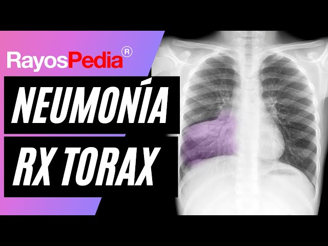Pneumonia and Air Bronchogram on Chest X-ray