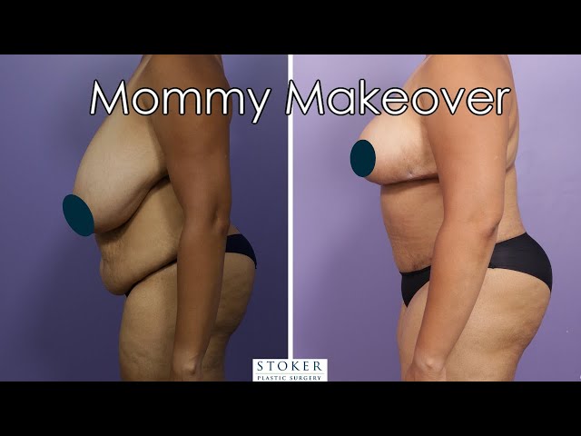 This Mom's Complete Body Transformation: Tummy Tuck to Breast Reduction