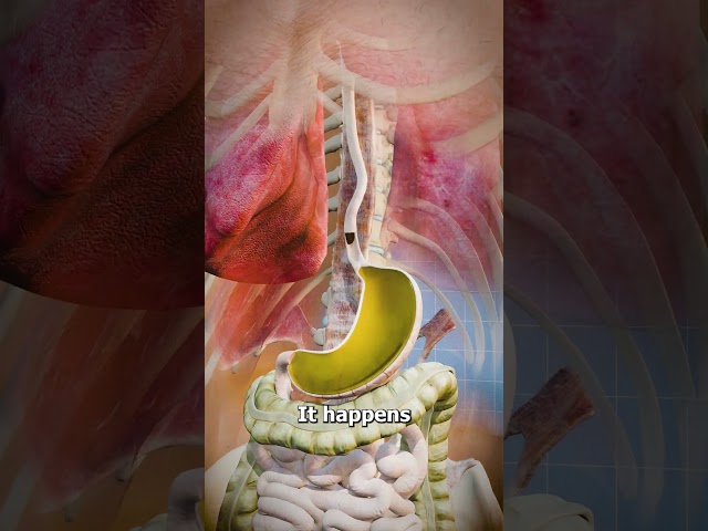 Acid Reflux Explained 🤔