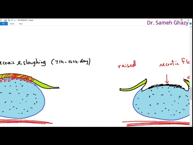Systemic pathology 29 : GIT 6  ( inflammations of intestine )   DR.SAMEH GHAZY
