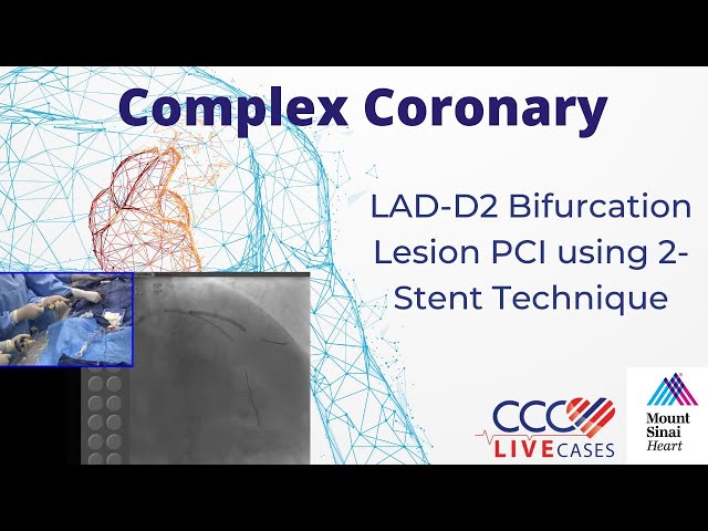 LAD-D2 Bifurcation Lesion PCI using 2-Stent Technique - CCC Live Oct 2016