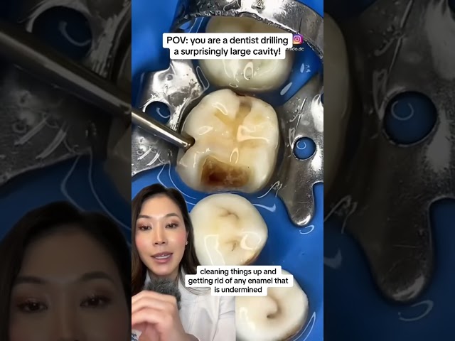 Uncovering a surprisingly large cavity! #cavity #drilling #dentist #bigcavity