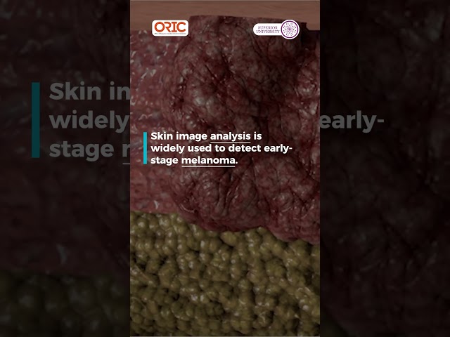 Revolutionising skin cancer detection through Image Processing #research #science #skincare