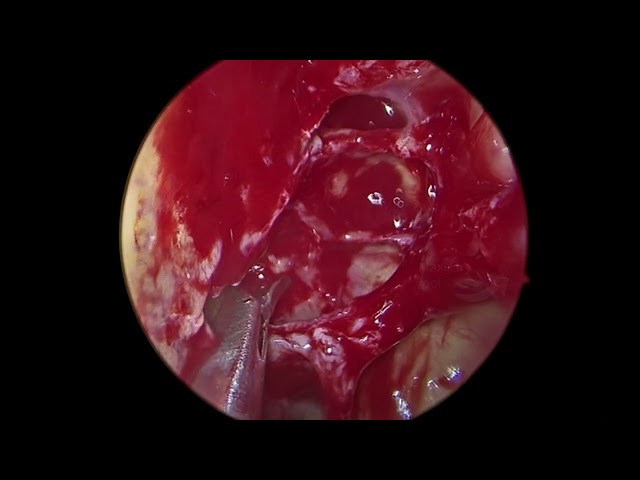 Full Functional Endoscopic Sinus Surgery (FESS) for sinusitis