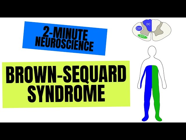2-Minute Neuroscience: Brown-Séquard Syndrome