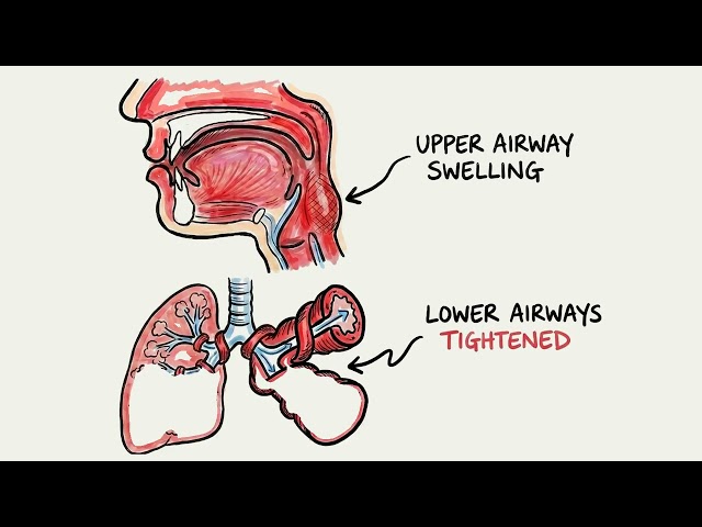Case Study: ANAPHYLAXIS