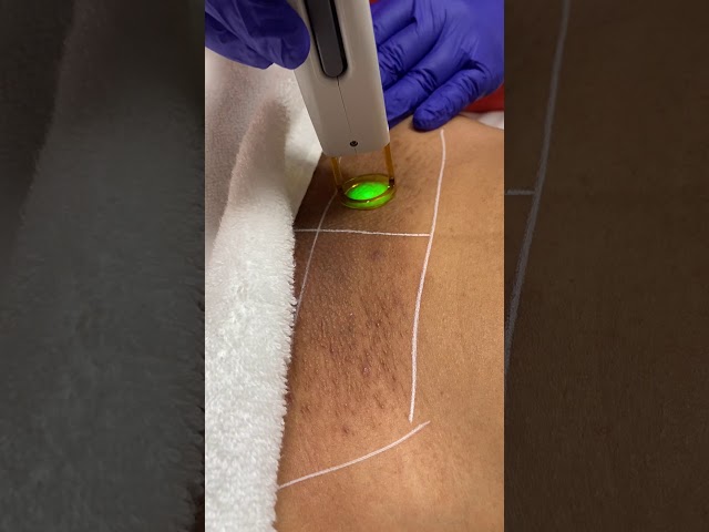 Brazilian Laser Hair Removal Session