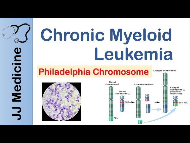 Leucemia mieloide crónica (LMC) | Patogenia, síntomas y tratamiento