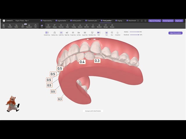 Angle Class III Malocclusion Clear Aligner Treatment Case - Best Smile Tech
