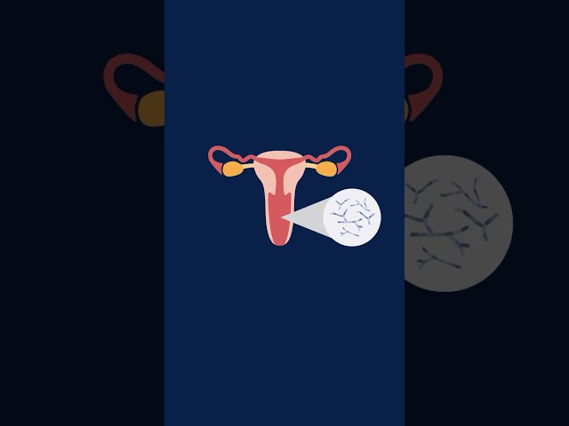 ¿Cuáles son los síntomas de la candidiasis vaginal?