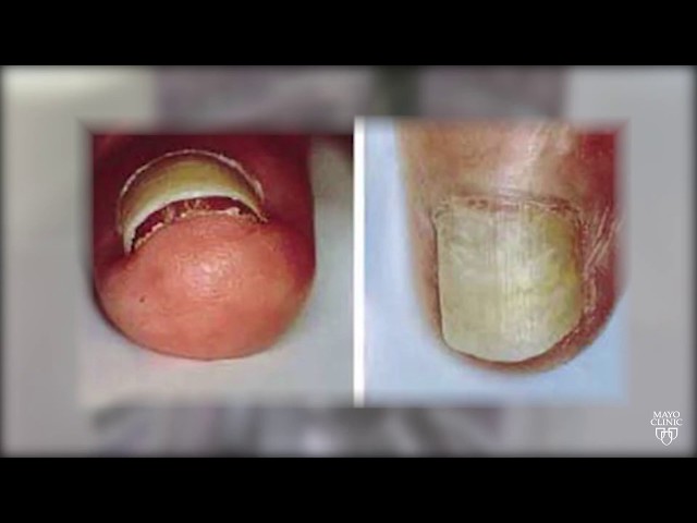 Mayo Clinic Minute: Fingernails are clues to your health