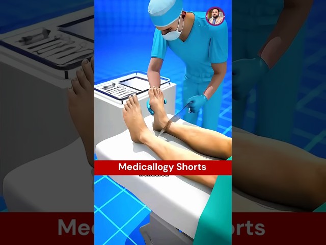 Rotation Plasty Surgery || How Ankle Becomes a Knee | Medicallogy #shorts