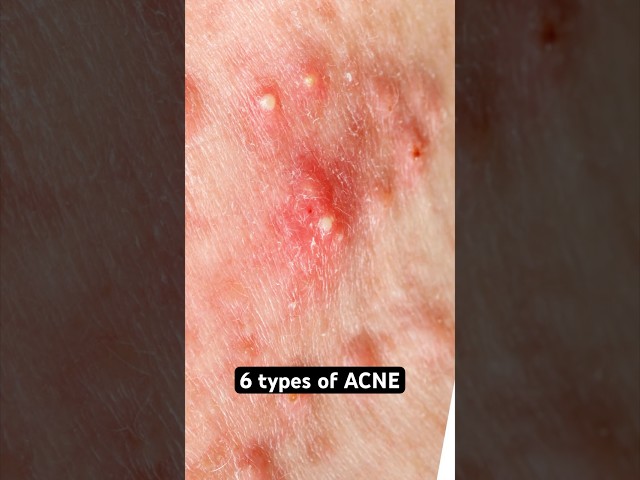 6 Types of Acne Explained #shorts #acne